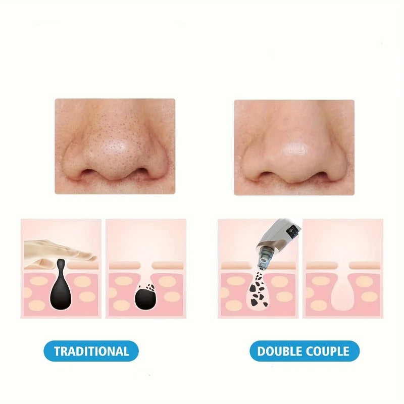 Blackheads, Whiteheads & Face Pores Cleaner & Suction Machine